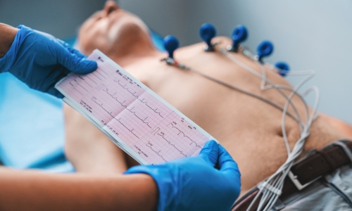 Electrocardiogram,,Ecg,In,Hand.,Cardiogram,Printout,On,Male,Patient,Background